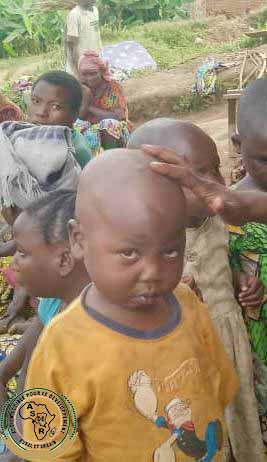 Lutte contre la malnutrition à Bushanga : 378 cas de malnutrition aiguë identifiés en septembre 2025